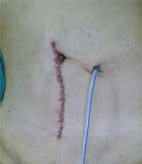 開腹乙狀結(jié)腸癌根治術(shù)切口.jpg