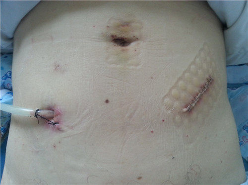 腹腔鏡乙狀結(jié)腸癌根治術(shù)切口.jpg